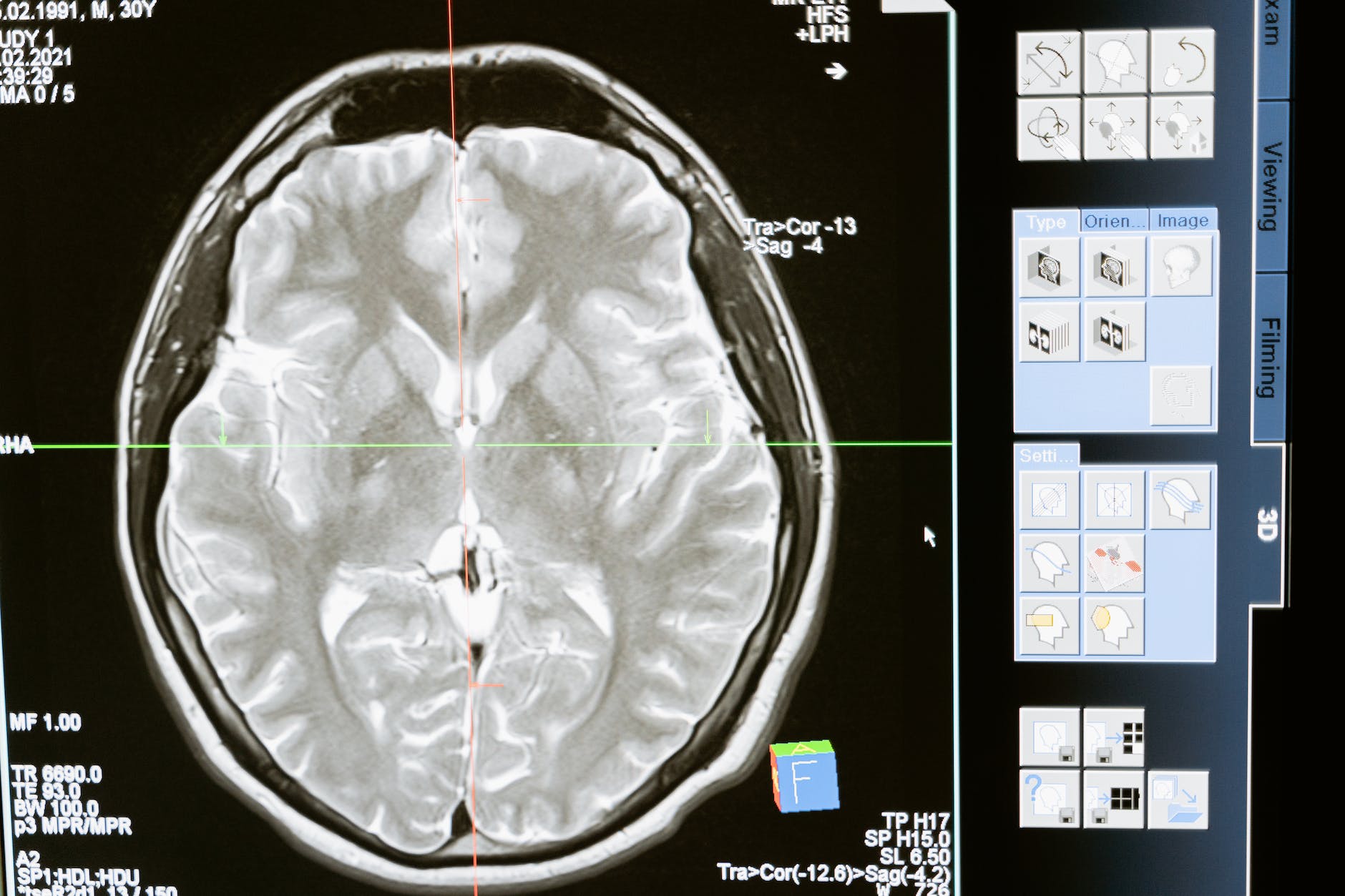 अल्जाइमर रोग: क्या होता है मस्तिष्क के अंदर जिससे जीवन जीना हो जाता है दुश्वार